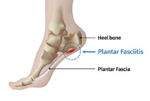 fascitis-plantar-podologia